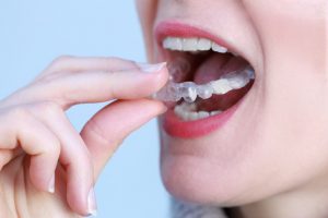 NTI-Schiene Aufeinanderreiben Zähne Aufbissschiene